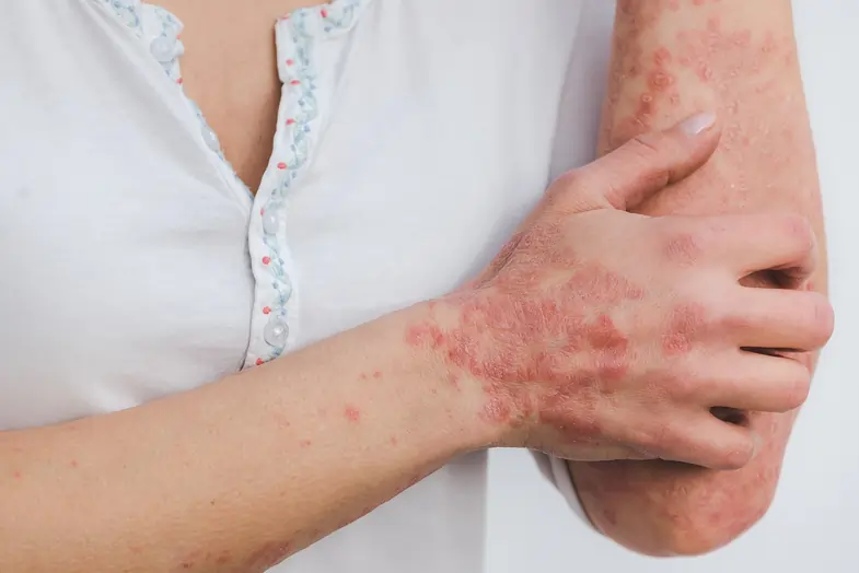 Enferma de psoriasis rascándose los brazos | Justbob